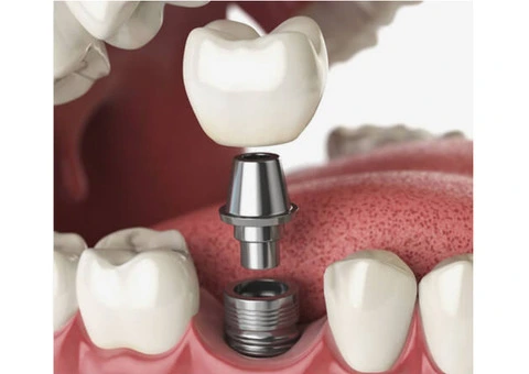 Experience Exceptional General Dentistry in Banksia Grove