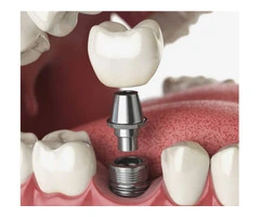 Experience Exceptional General Dentistry in Banksia Grove