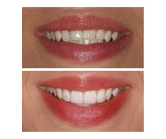 Explore Stunning Dental Veneers Before and After Transformations