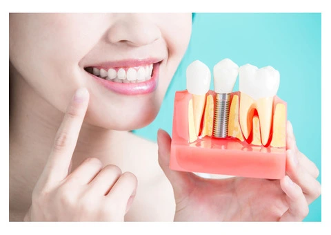 Transform Your Smile with Dental Implants in Townsville