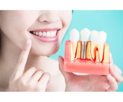 Transform Your Smile with Dental Implants in Townsville