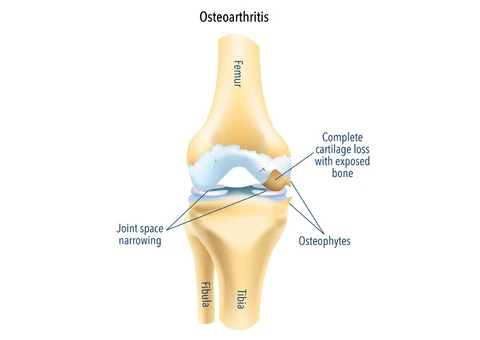 Effective Osteoarthritis Knee Treatment Options Available