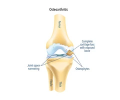 Effective Osteoarthritis Knee Treatment Options Available