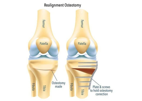 A Straight Shot at Healing with Osteotomy Surgery