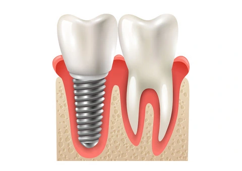 Looking for top-quality dental implants in Perth?
