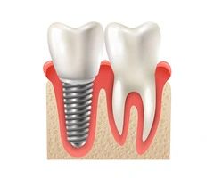 Looking for top-quality dental implants in Perth?