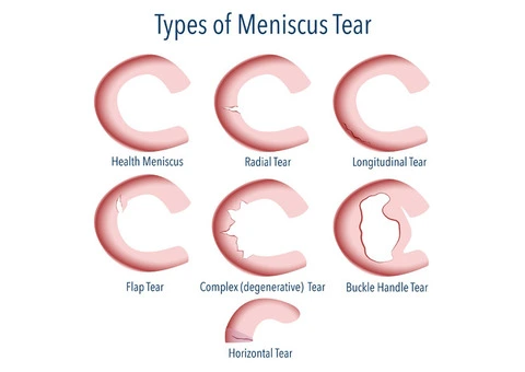 Maximise Recovery and Minimise Scarring with Arthroscopic Meniscectomy