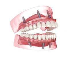 Get Your Smile Back with All-on-4 Dental Treatment in Warriewood