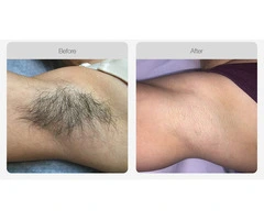 SHR Hair Removal Treatment | Waxing Queen Salon