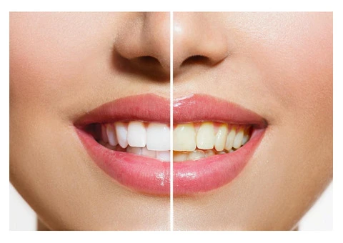 Brighten Your Smile: Premier Teeth Whitening in Victor Harbor