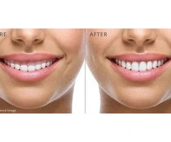 Gentle Dental Budgewoi - Tooth Whitening Budgewoi