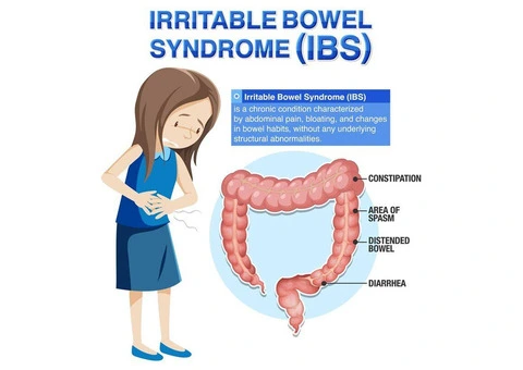 Treat IBS Symptoms Early with BNC