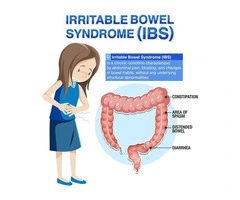 Treat IBS Symptoms Early with BNC