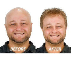 Affordable Hair Pieces for Men: Quality on a Budget