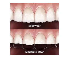 Restore Your Smile with Worn Teeth Treatment Solutions