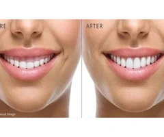 Gentle Dental Bateau Bay - Tooth Whitening Bateau Bay