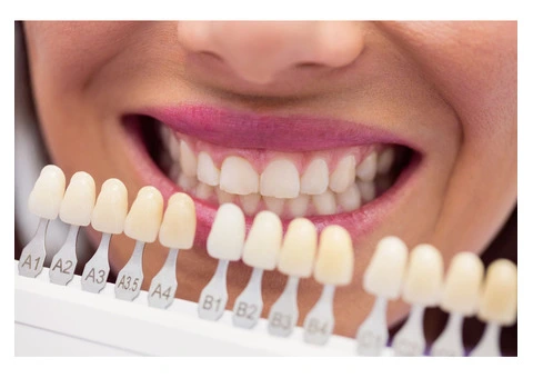 Transform Your Smile with Dental Veneers in Box Hill