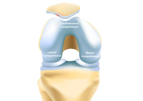 Regain Your Mobility with Advanced Partial Knee Surgery
