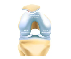 Regain Your Mobility with Advanced Partial Knee Surgery