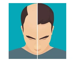 Checkout the Top Hair Replacement and Restoration from Hair Loss Perth Experts