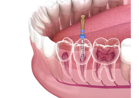 Expert Root Canal Treatments at Affordable Prices