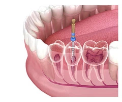 Expert Root Canal Treatments at Affordable Prices