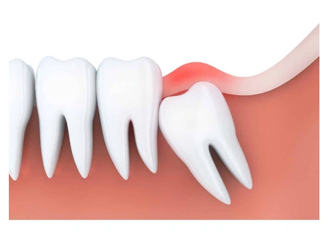 Quick Recovery Wisdom Teeth Removal Techniques
