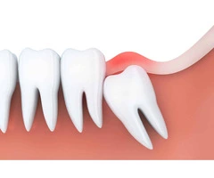 Quick Recovery Wisdom Teeth Removal Techniques