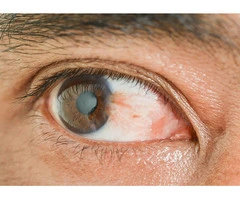 Get Clear Vision with Eye Pterygium Surgery