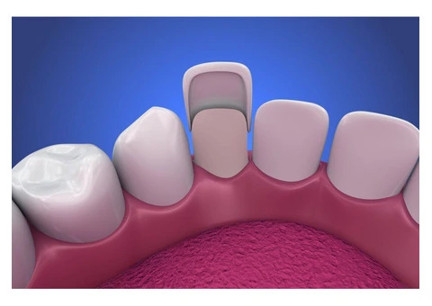 Porcelain Veneers Sydney- Delight Dental Spa