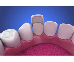 Porcelain Veneers Sydney- Delight Dental Spa