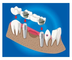 Transform Your Smile with All-On-4 Dental Implants