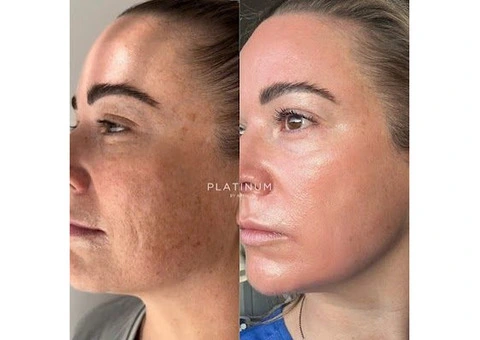 Best Dermal Filler treatment in Page