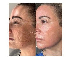 Best Dermal Filler treatment in Page