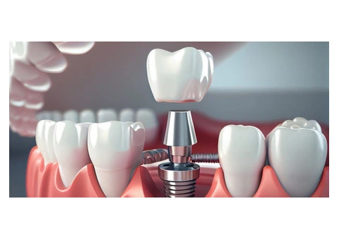 Discover Your Perfect Smile with Free Dental Implant Consultation in Banksia Grove
