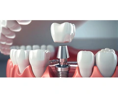 Discover Your Perfect Smile with Free Dental Implant Consultation in Banksia Grove