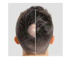 Learn About The Seamless Integrated Hair System for Men from Hair Loss Clinic Perth