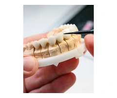 Discover Affordable Permanent Veneers Cost