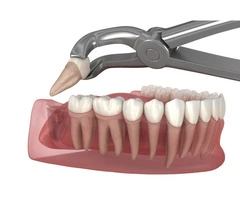 Expert Wisdom Teeth Removal: Get Relief Fast