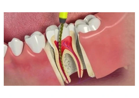 Get Relief with Our Specialized Root Canal Services