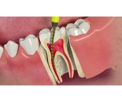 Get Relief with Our Specialized Root Canal Services