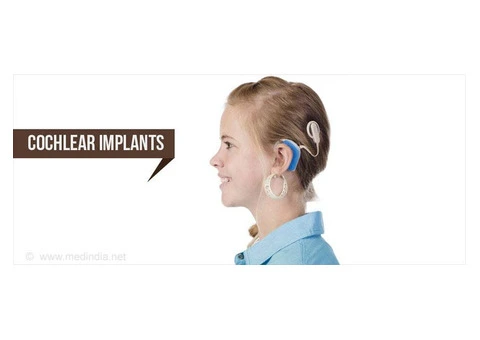 Decoding Sound: Innovations in Cochlear Implant Electrode Design and Function"