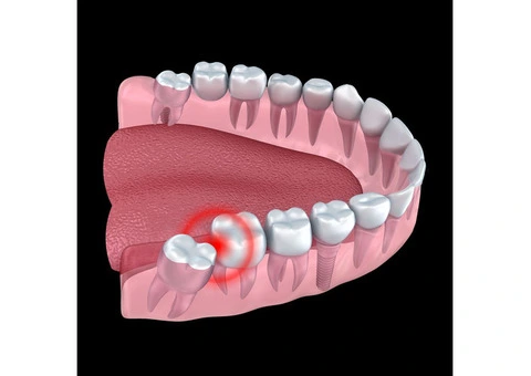 Pain-Free Wisdom Teeth Removal by Experienced Dentists