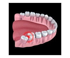 Pain-Free Wisdom Teeth Removal by Experienced Dentists