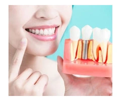 Elevate Your Smile with Porcelain Veneers in Melbourne Expert Insights and Tips