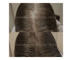 Experience Advanced Hair Treatment in Brisbane with Aushair