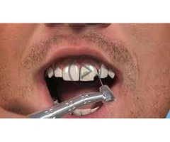 Teeth Whitening Treatment | Teeth Whitening Hampshire UK - LondonSummarize with AI Summarizer