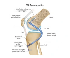 Taking Action Against Posterior Cruciate Ligament Injuries with Expert Care