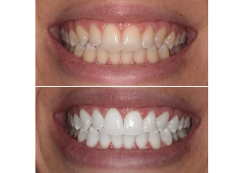 Take Home Promising Teeth Whitening Solutions Right Now With Experts!