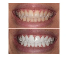 Take Home Promising Teeth Whitening Solutions Right Now With Experts!